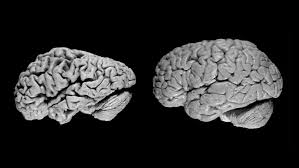 Brains from Alzheimer's patient (left) and normal patient (right)